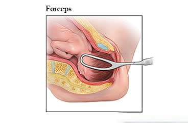 Forceps-assisted delivery.