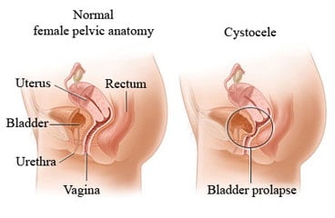 Normal female pelvic anatomy and of cystocele.