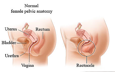 Picture of normal female anatomy and rectocele.