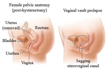 Female pelvic anatomy after hysterectomy showing uterus removed, and anatomy with vaginal vault prolapse showing sagging uterovaginal canal.