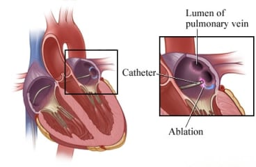 Catheter ablation inside the heart.