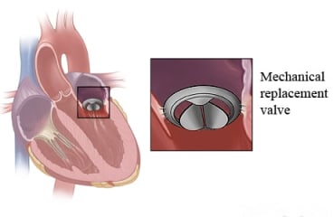 Artificial replacement valve and where it fits in the heart.