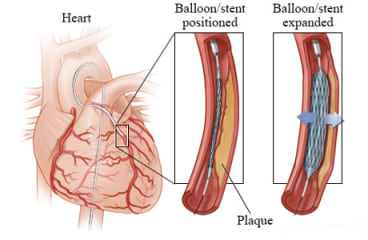 Coronary artery with a stent