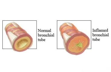 Normal and inflamed airways.