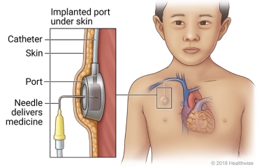Location of an implanted port in the chest, with detail of the port under the skin.