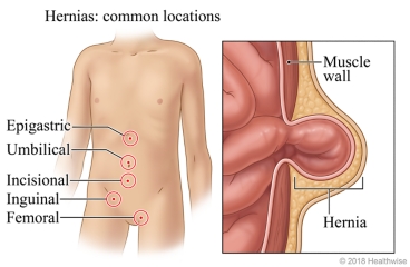 Locations of epigastric, umbilical, incisional, inguinal, and femoral hernias, with detail of a hernia protruding through the muscle wall.