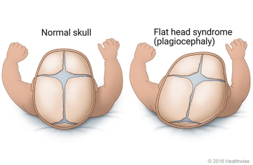 Side-by-side view of normal infant skull and infant skull with flattening on one side.