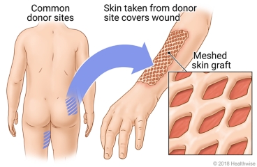 Location of some common sites on the body for donor skin, with detail of meshed skin graft covering wound.