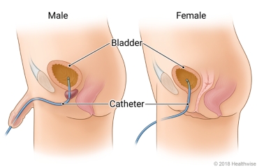 Catheter tube running from inside the bladder to outside the body in male and female bodies.