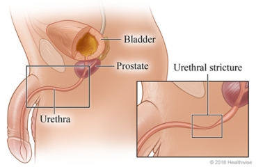 Male urinary tract showing bladder, prostate, and urethra, with detail of urethral stricture.