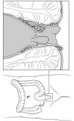 Internal and external hemorrhoids