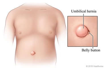 An umbilical hernia next to the belly button.