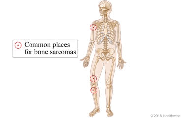 Common places for bone sarcomas, including above and below the knee and on the upper arm.