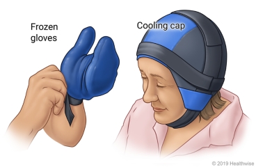 Examples of a frozen glove and a cooling cap.