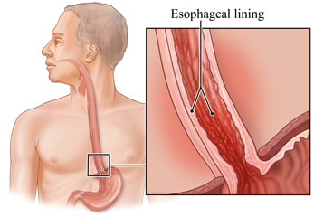 Esophagus with detail of esophageal lining.