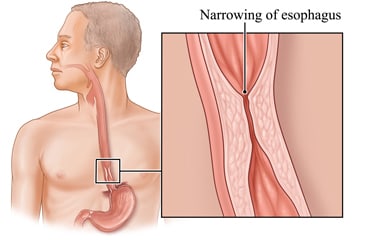 Esophagus with detail of narrow section