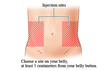 Injection sites, to either side and at least 2 inches from belly button.