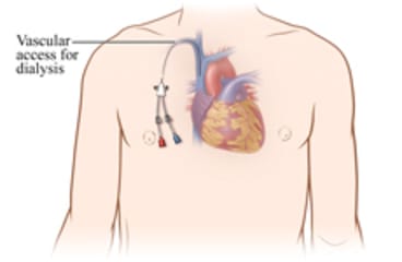 Chest with catheter for hemodialysis and vascular access