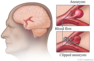 Before and after surgery to repair an aneurysm with a clip.