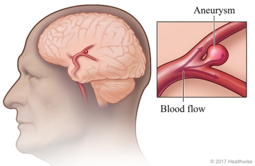 Aneurysm in brain, with detail of bulge in artery.