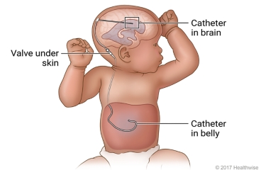 VP shunt, showing the catheter in the belly, the catheter in the brain, and the valve under the skin
