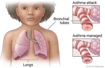 Lungs in child's chest showing bronchial tubes, with detail showing narrowed tube in asthma attack and partly opened tube in managed asthma.