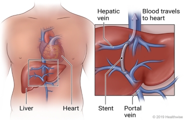 Location of liver below heart, with close-up of stent in liver joining portal vein and hepatic vein.