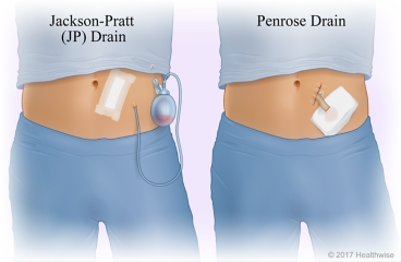 Surgical drain tube with bulb on the end and surgical drain tube that is open to dressing.
