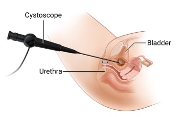 Cystoscope placement through urethra into bladder.