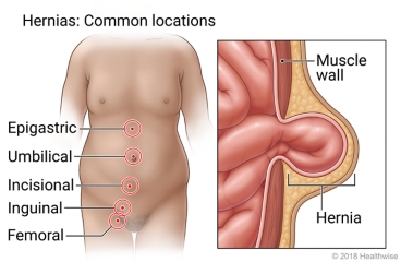 Common locations of hernias, showing epigastric below chest, umbilical at belly button, incisional at surgical incision site, inguinal at groin, and femoral at upper leg, with inside view of intestine protruding from hole in muscle wall.