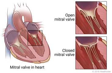 Inside view of heart showing location of mitral valve between two chambers of the heart, with detail of open valve and closed valve.