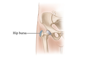 Location of the bursa at the outside of the hip