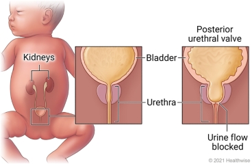 Healthy urethra and bladder compared to urethra with blocked urine flow to the bladder (posterior urethral valve)