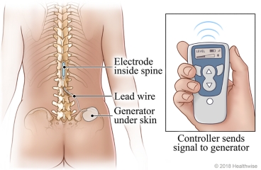 Spinal cord stimulator with lead wire, generator, and wireless controller.