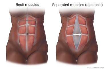 Diastasis rectus abdominis