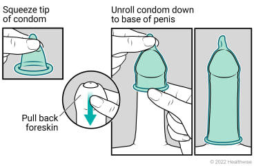 Rolled-up external (male) condom, foreskin of penis being pulled back, and condom unrolled to base of erect penis.