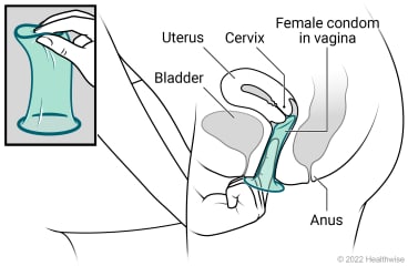 Female pelvic organs, showing a uterus, cervix, bladder, and anus, with detail of internal (female) condom and placement in vagina.