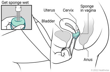 Female pelvic organs, showing a uterus, cervix, and bladder, with spermicide put in cervical cap and placed in vagina at cervix.