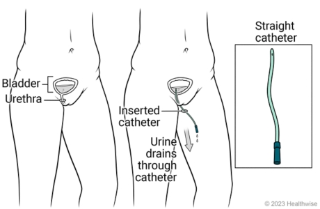 Bladder and urethra, showing catheter inserted in urethra and urine draining through catheter, with detail of straight catheter.