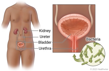 Female urinary tract in teen, showing kidney, ureter, bladder, and urethra, with detail of bacteria entering urethra to bladder.