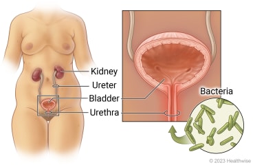 Female urinary tract, showing kidney, ureter, bladder, and urethra, with detail of bacteria entering urethra to bladder.