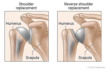 Shoulder replacement, with ball of joint attached to humerus, compared to reverse shoulder replacement, with ball of joint attached to scapula.