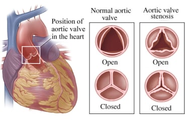 Normal aortic valve and a valve with stenosis