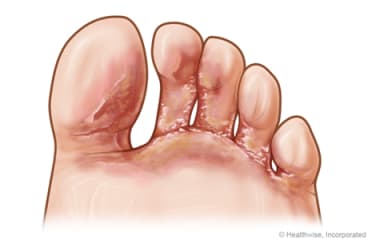 Vesicular-type athlete's foot between the toes.