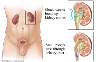 Kidneys and lithotripsy.