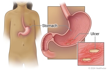 Location of stomach in body, with cross-section of stomach and detail of ulcers in stomach.
