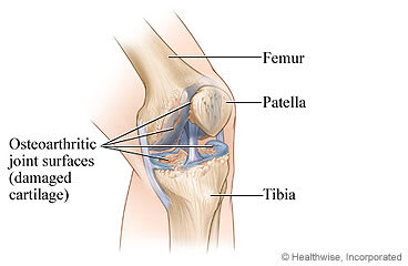 Knee joint with osteoarthritis.