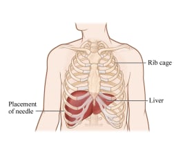 Where a liver biopsy needle is placed between two right lower ribs