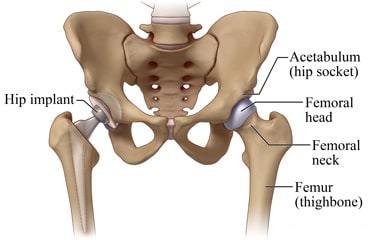 Normal hip and total hip replacement.
