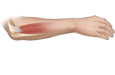 Tennis elbow anatomy: side view.